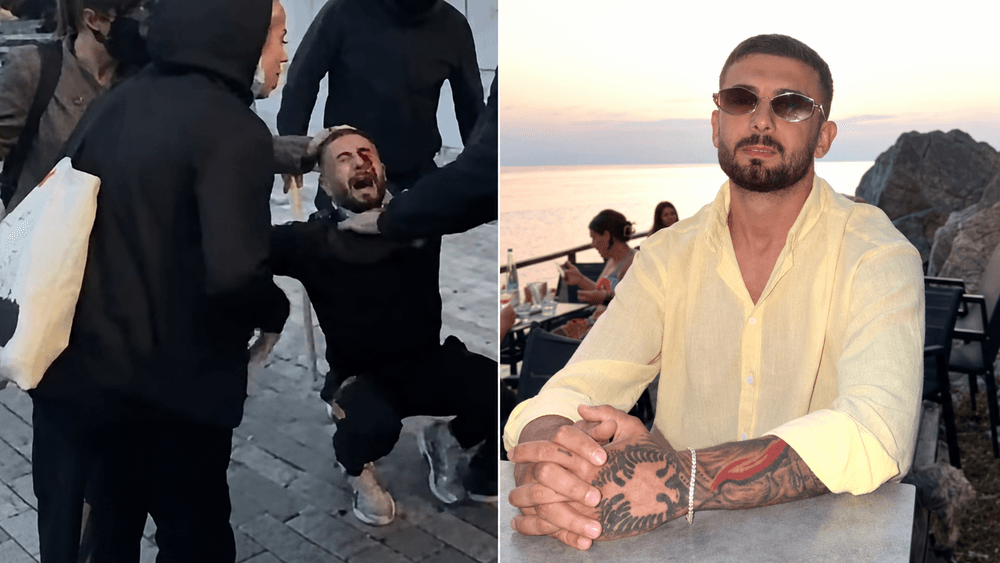 U godit me plumb gome në sy gjatë protestës/ 28-vjeçari, Erjon Vishkulli humbet shikimin në syrin e majtë